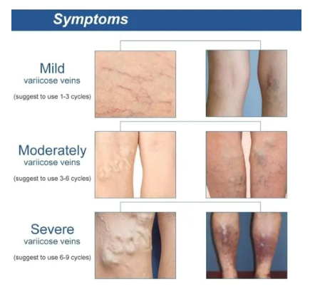 Vista 3 de 10 Parches de circulacion VARICES